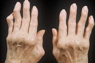 Лечение артрита в Волгограде - цена в клинике «Волжская здравница» Лечение ревматоидного артрита в Волгограде по доступной цене в клинике «Волжская здравница»