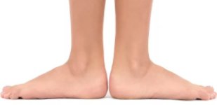 Лечение плоскостопия в Волгограде