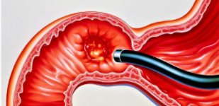 Лечение язвы желудка и двенадцатиперстной кишки в Волгограде «Волжская здравница»