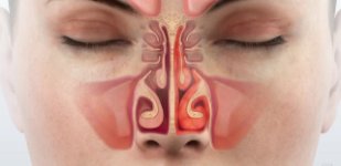 Лечение синусита в Волгограде