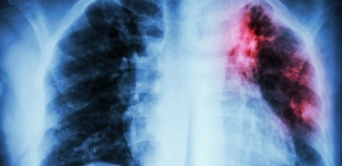 Лечение органов дыхания в Волгограде - Волжская Здравница Лечение пневмонии в Волгограде