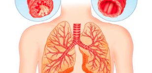 Лечение органов дыхания в Волгограде - Волжская Здравница Хроническая обструктивная болезнь легких