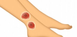 Лечение трофических язв в Волгограде «Волжская здравница»