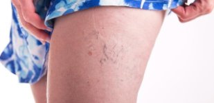 Лечение варикоза в Волгограде