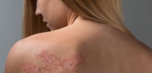 Лечение заболеваний кожи в Волгограде Лечение псориаза в санатории