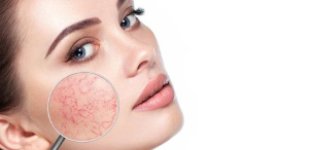 Лечение заболеваний кожи в Волгограде Лечение розацеа в Волгограде «Волжская здравница»