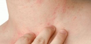 Лечение заболеваний кожи в Волгограде Лечение почесухи в Волгограде «Волжская здравница»