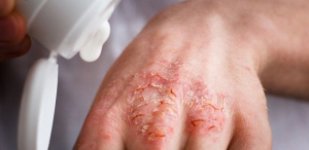 Лечение заболеваний кожи в Волгограде Лечение экземы