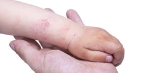 Лечение заболеваний кожи в Волгограде Лечение атопического дерматита