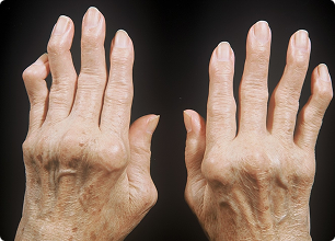 Лечение ревматоидного артрита в Волгограде по доступной цене в клинике «Волжская здравница»